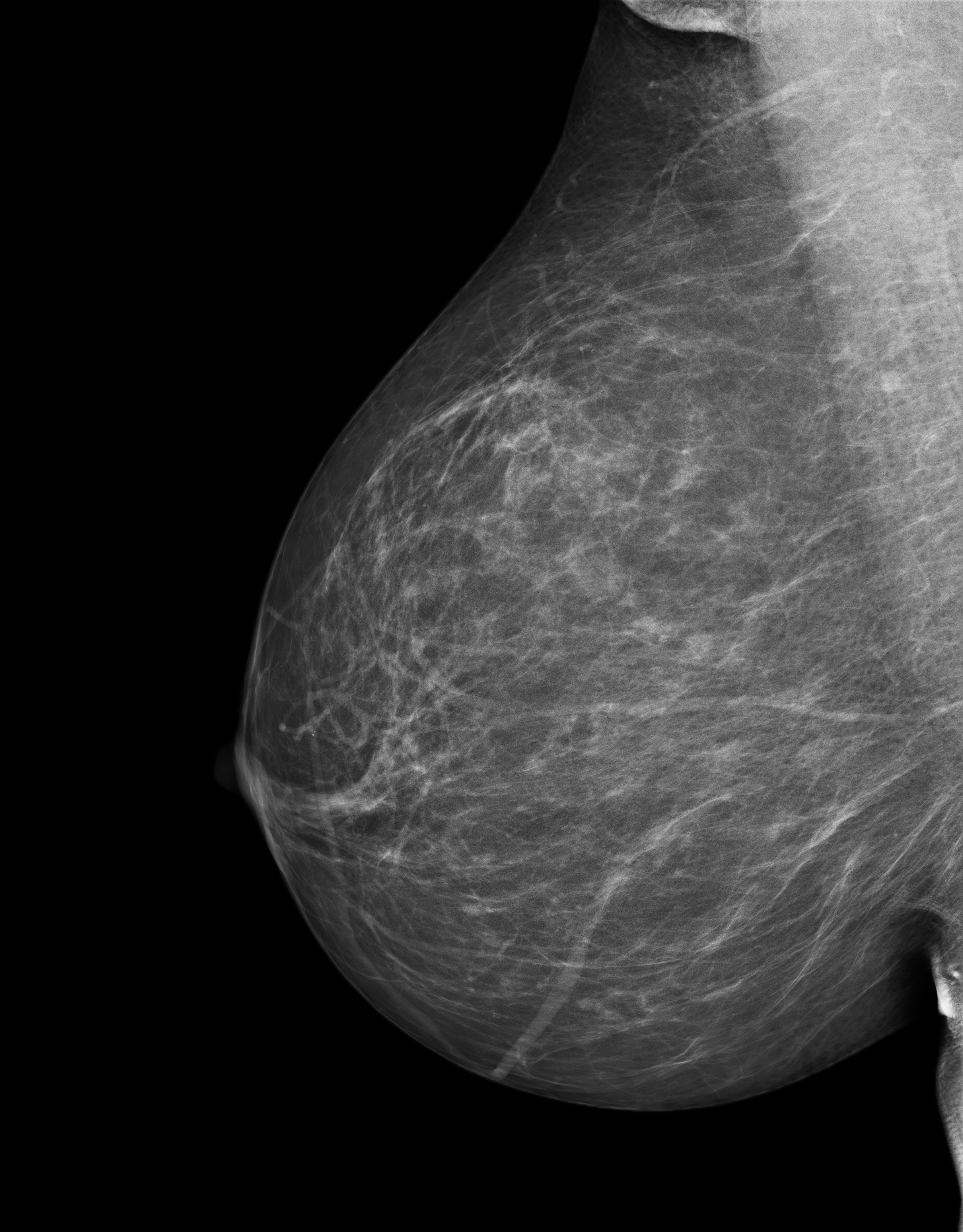 Mammogram